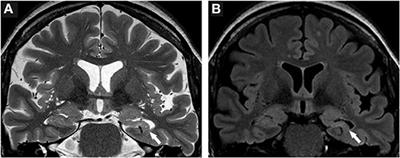 Histopathologic Characterization and Neurodegenerative Markers in Patients With Limbic Encephalitis Undergoing Epilepsy Surgery